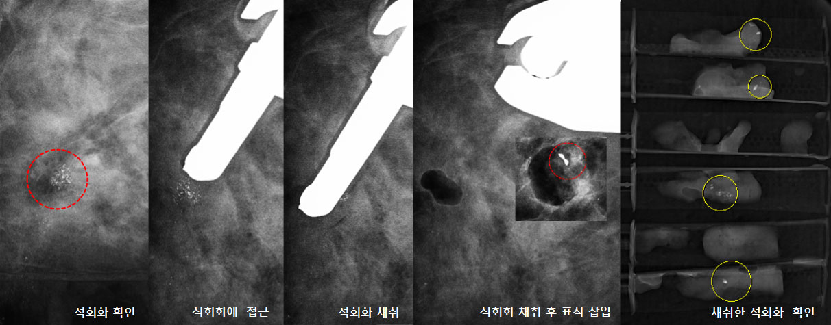 입체적 정위-유방생검술 과정