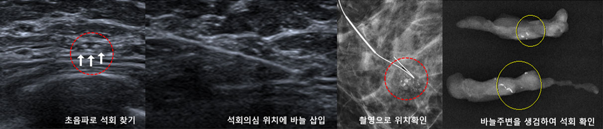 바늘위치결정술 후 생검술